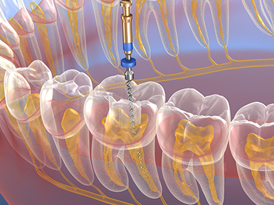 The image shows a close-up of a human mouth with teeth, a tongue, and gums. There is a dental drill in operation near the lower front teeth, and a blue object resembling a toothbrush or cleaning tool is being used to clean or remove debris from between the teeth. The background highlights the internal structure of the mouth, including the upper jaw with teeth and the tongue.